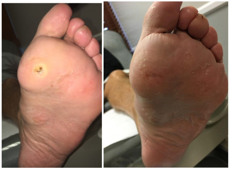 Pre and Post Injection Skin Lesion