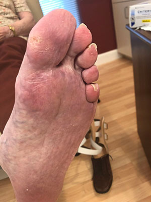 loss of fat pad on ball of foot