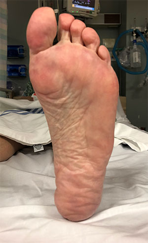loss of fat pad on ball of foot