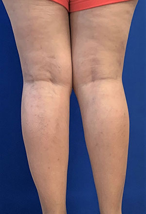 Varicose Veins Patient