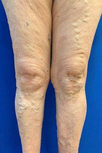 Venaseal for Varicose Veins