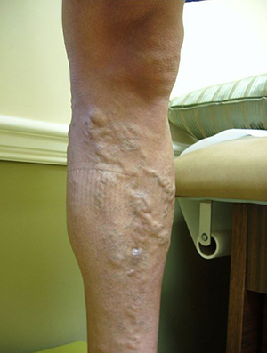 Human papillomavirus infection apple cider vinegar