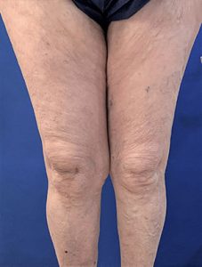 Venaseal for Varicose Veins