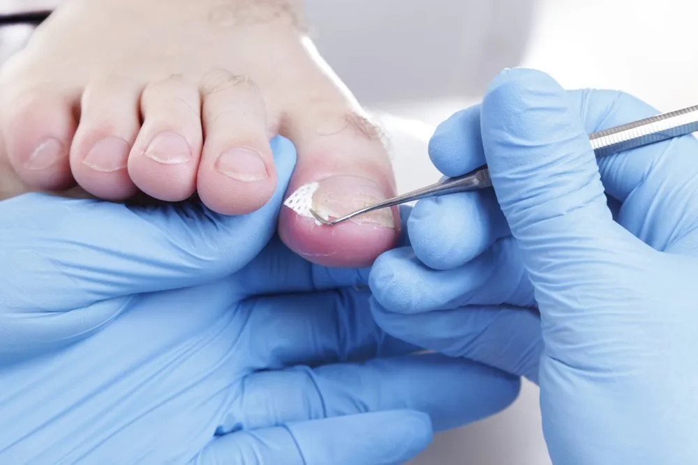 Treating Ingrown Toenails in Boynton Beach