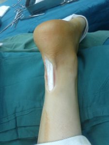 Achilles Tendon Injuries Learn When It s Time to Visit Your Podiatrist