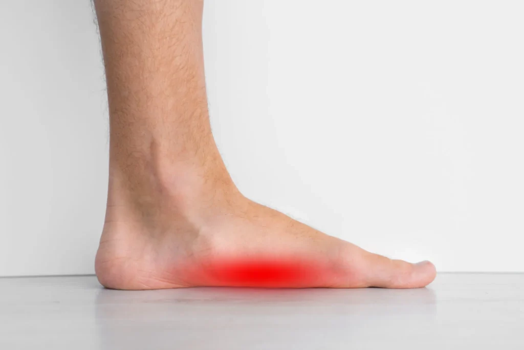 Surgical Correction for Flat Feet
