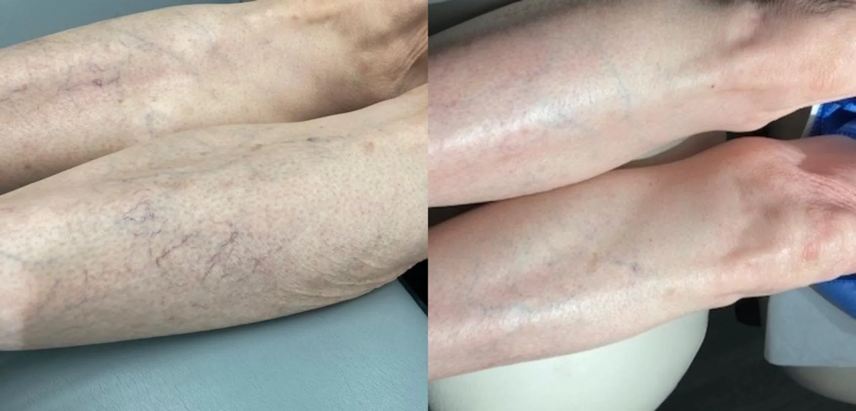 Vein Treatment
