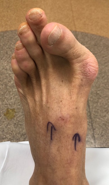 BunionLeftFoot 1