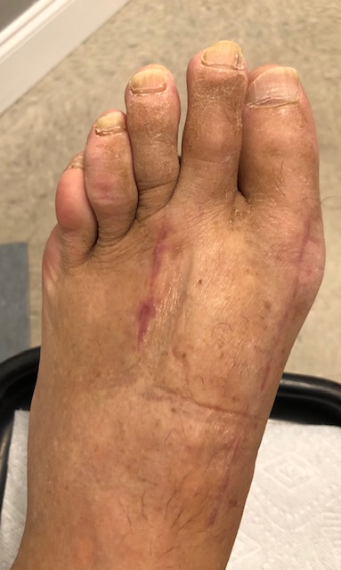 7 Weeks after Lapiplasty bunionectomy and Weil osteotomy.