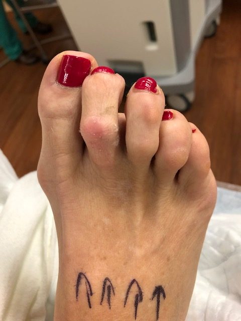 hammertoes 2-4 right foot and bunion