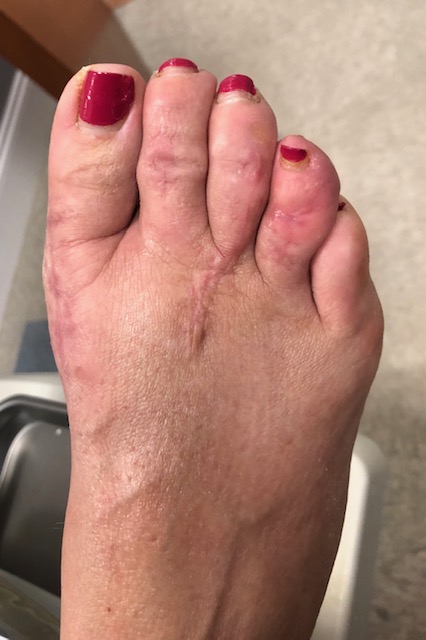 post op hammertoe surgery