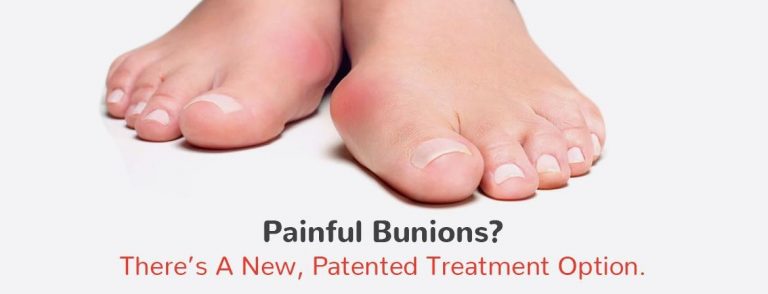 bunion 1