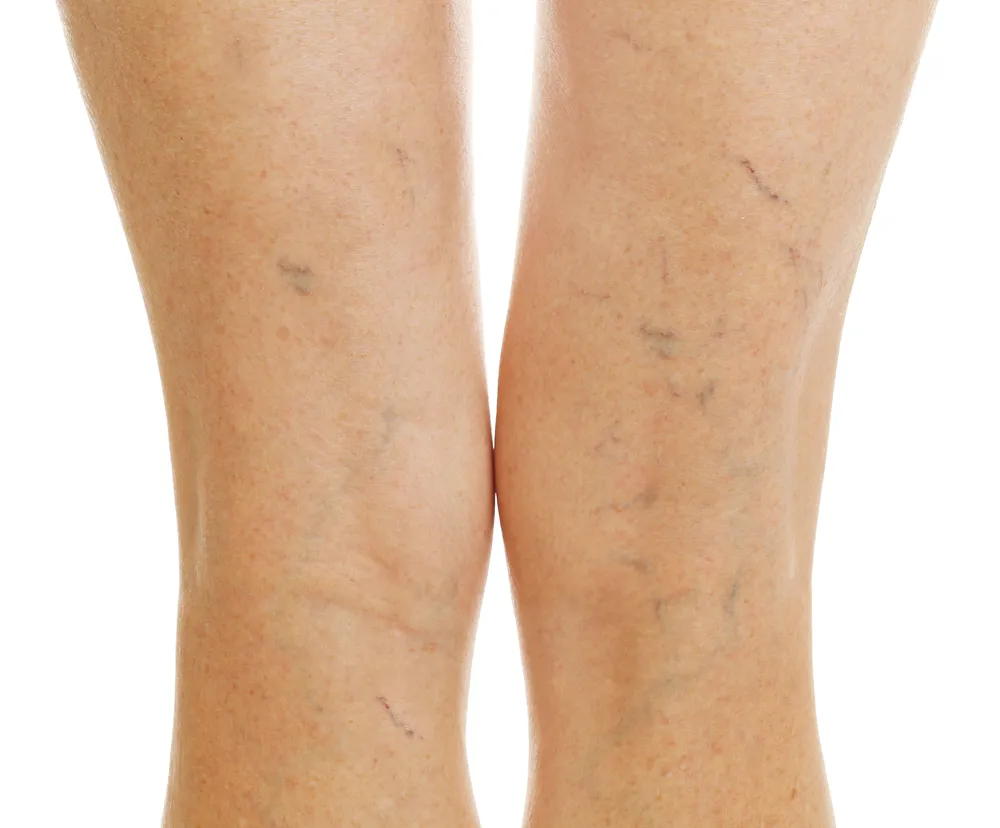 venaseal for varicose veins treatment