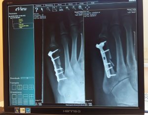 Surgery with a Board-Certified Foot and Ankle Doctor