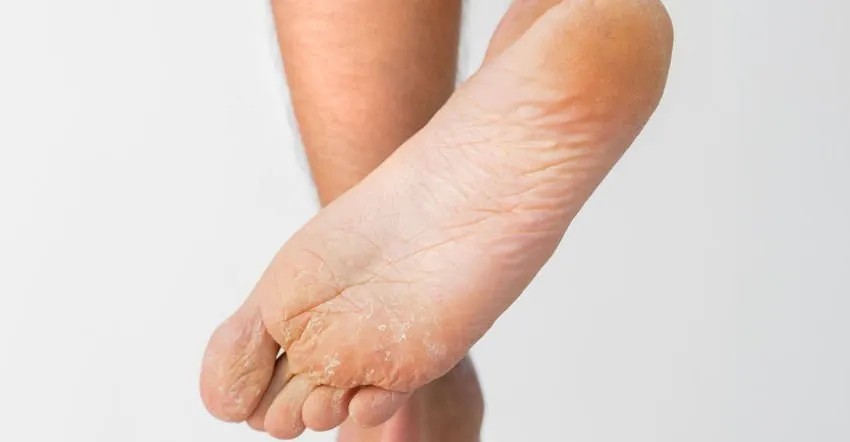 hyperhidrosis of the feet