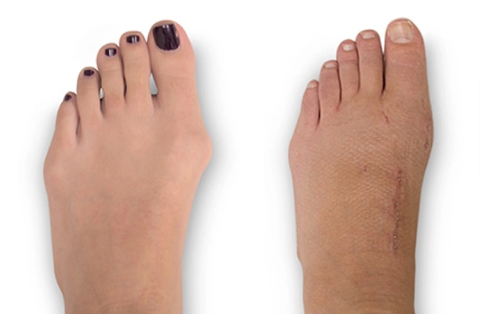 New Lapiplasty® 3D Bunion Correction