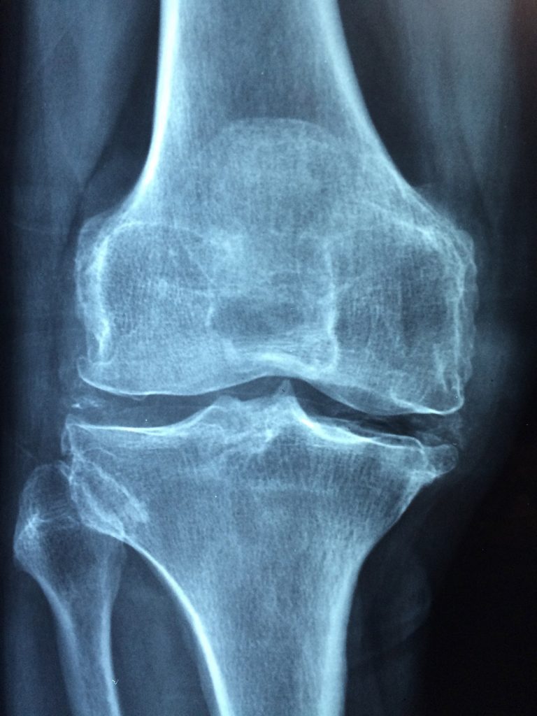 knee 1406964 1920 1