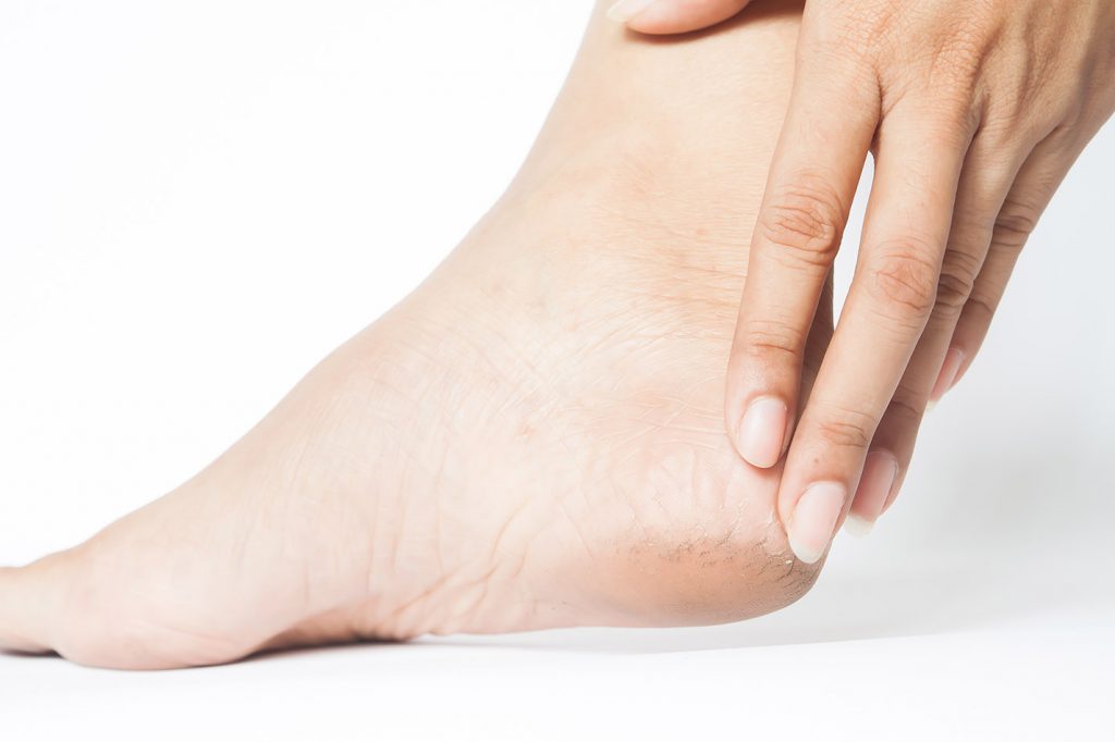 Symptoms and Treatments for Athlete’s Foot