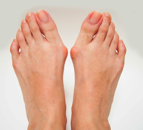 Fat Pad Atrophy Treatment - Foot, Ankle & Leg Vein Center