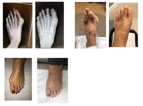 Lapiplasty