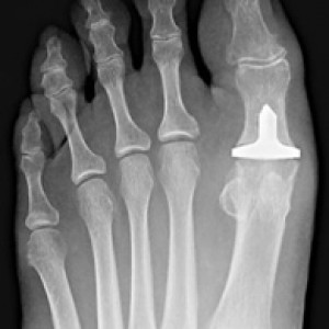 Joint Implant Post Surgery 1 300x300 1