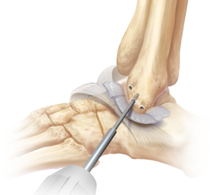 ankleinstabiltiyrepair 300x278 1