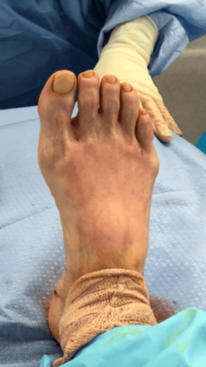 Plantar Fasciitis heel foot pain: Cortisone pain relief injection