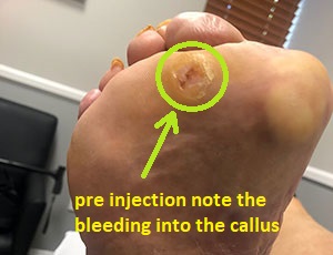 preinjection fat pad callus