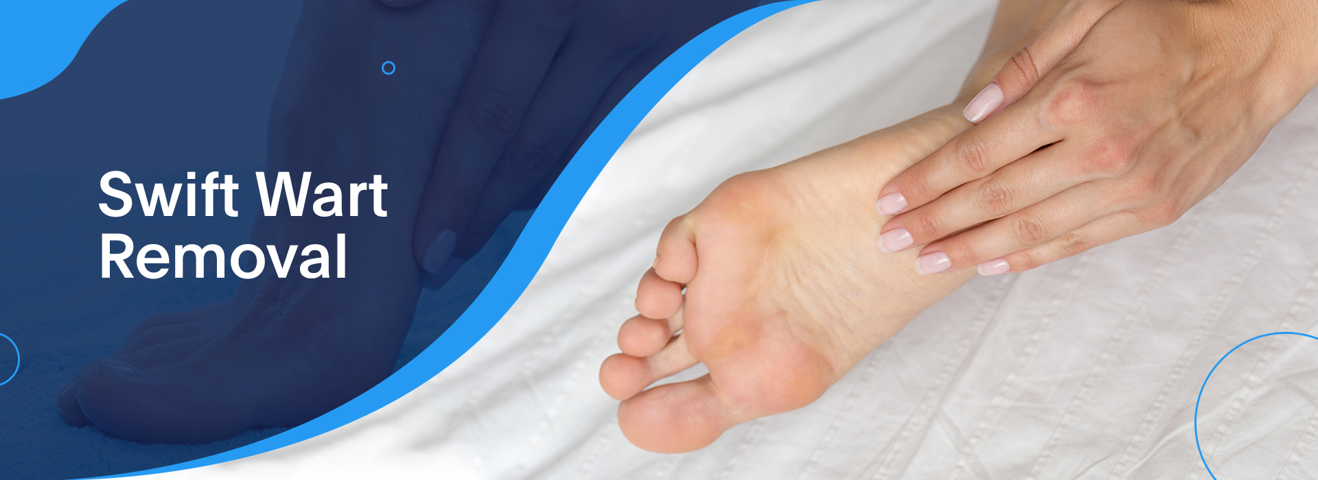 Swift Wart Removal