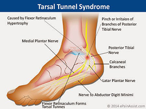 Tarsal Tunnel