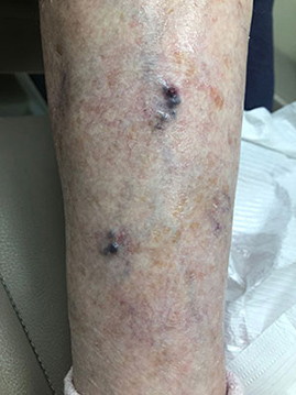 bleeding varicose vein