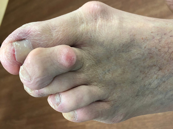 bunion treatment boca raton 1