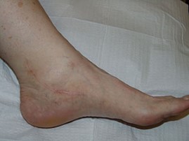 laser scar after patient 1