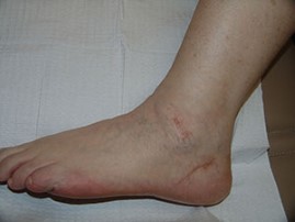 laser scar after treatment patient 2