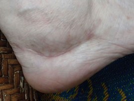 laser scar after treatment patient 3