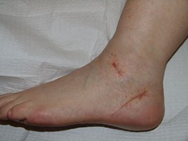 laser scar before treatment patient2