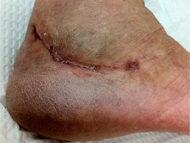 laser scar before treatment patient3 1 300x225 1