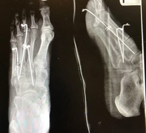 lisfranc treatment boca raton 300x274 1