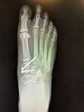 lisfranc treatment boynton beach 1