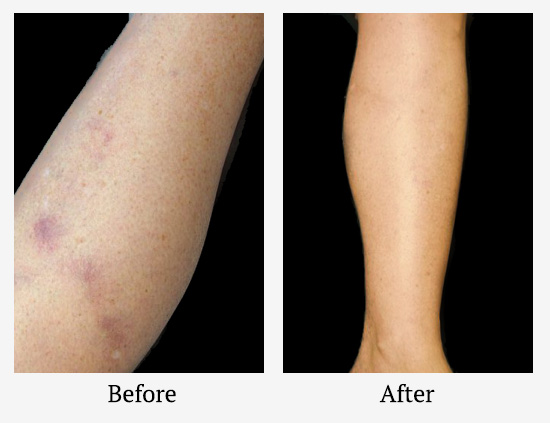 spider-vein-treatment-boca-raton-before-after-01.jpg