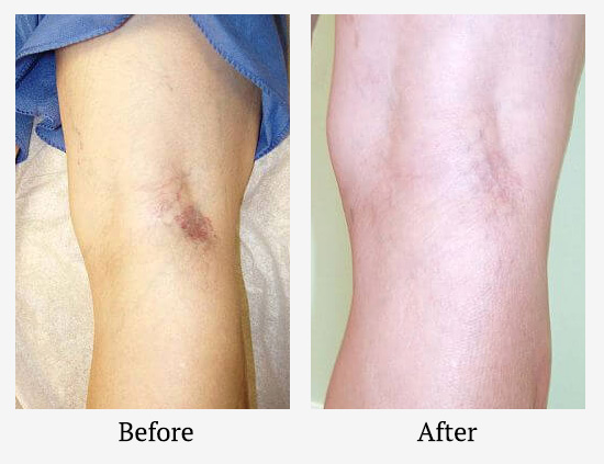 spider-vein-treatment-boca-raton-before-after-02.jpg