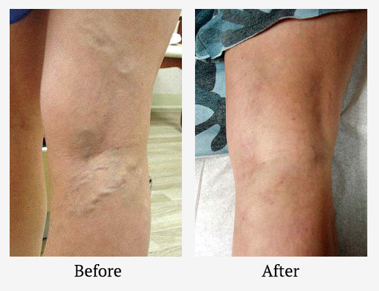 varicose-vein-treatment-boca-raton-before-after-01.jpg