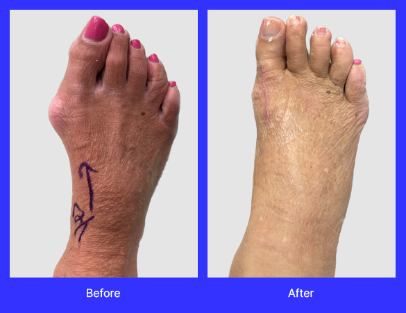 Before and after Gold bunionectomy. Patient is six weeks post operative