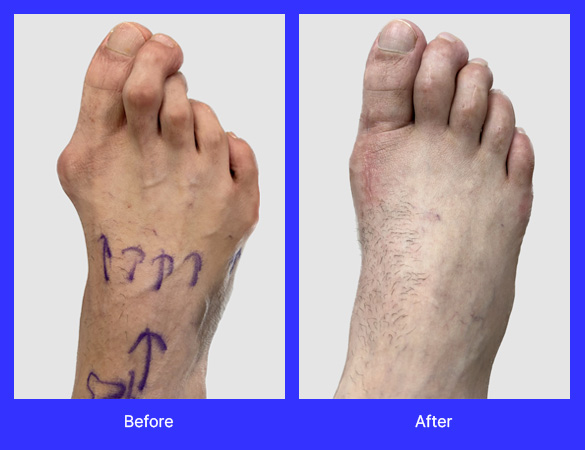 Patient had Gold bunionectomy and hammertoe correction of toes 2,3, 4 and 5. Pre operative and post operative pictures