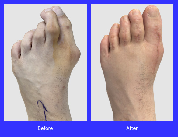 Gold bunionectomy with hammertoe repair. Pre op and post op pictures