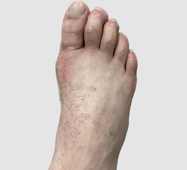 Post operative gold bunionectomy and hammertoe repair of 2nd , 3rd , 4th and 5th toes