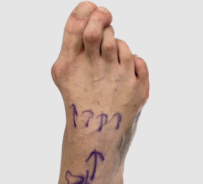 Pre op bunion and hammertoe patient