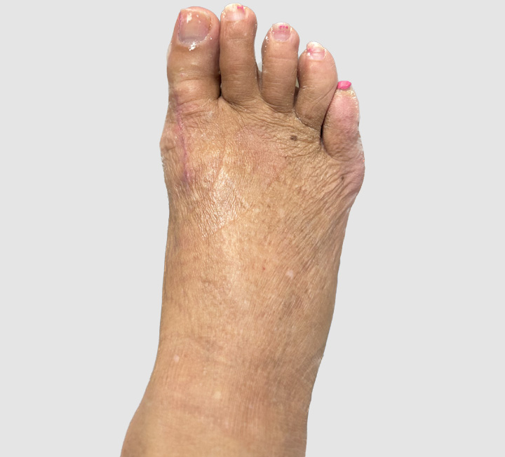 6 week post op Gold bunionectomy