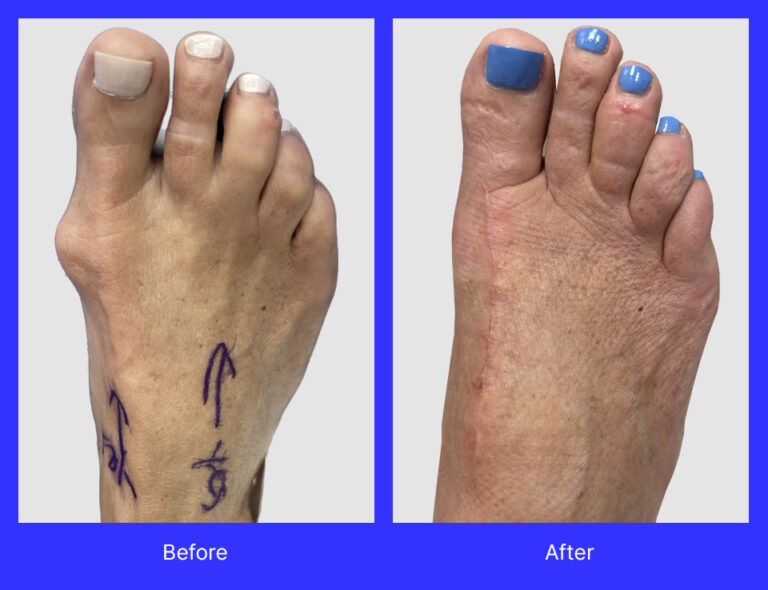 Lapiplasty bunionectomy, hammertoe repair, and removal of myxoid cyst third toe, performed by Dr. Jason Gold, DPM, FACFAS.