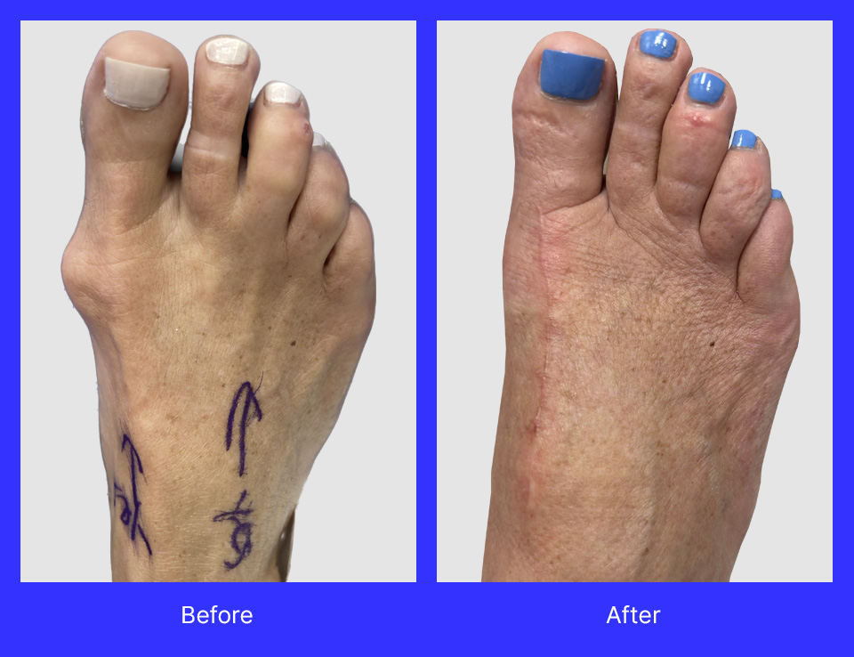 Lapiplasty bunionectomy, hammertoe repair, and removal of myxoid cyst third toe, performed by Dr. Jason Gold, DPM, FACFAS.